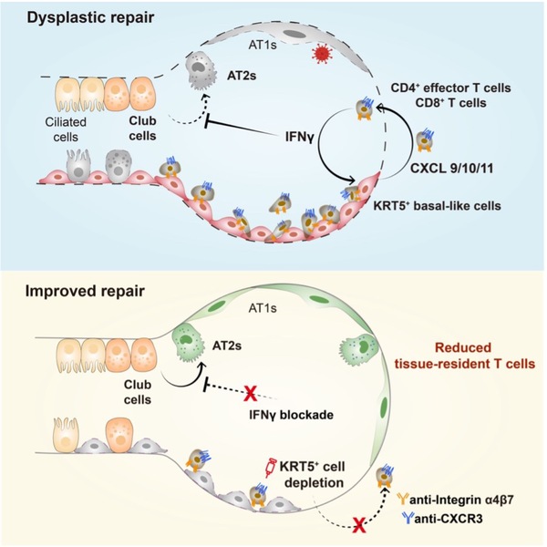 Scientists reveal the pathogenic role of dysplastic epithelial cells in lymphocyte tissue residence and alveolar regeneration   
