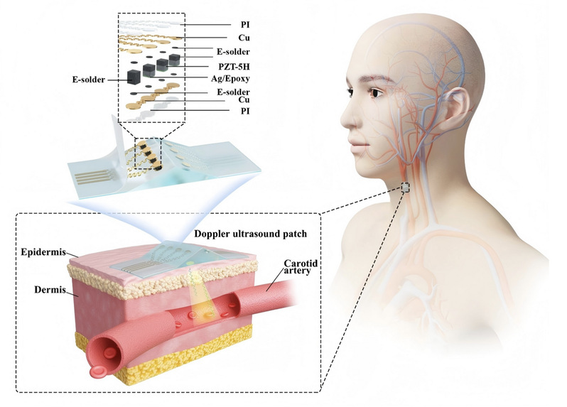 BME team develops stretchable Doppler ultrasound patch for continuous blood flow monitoring  