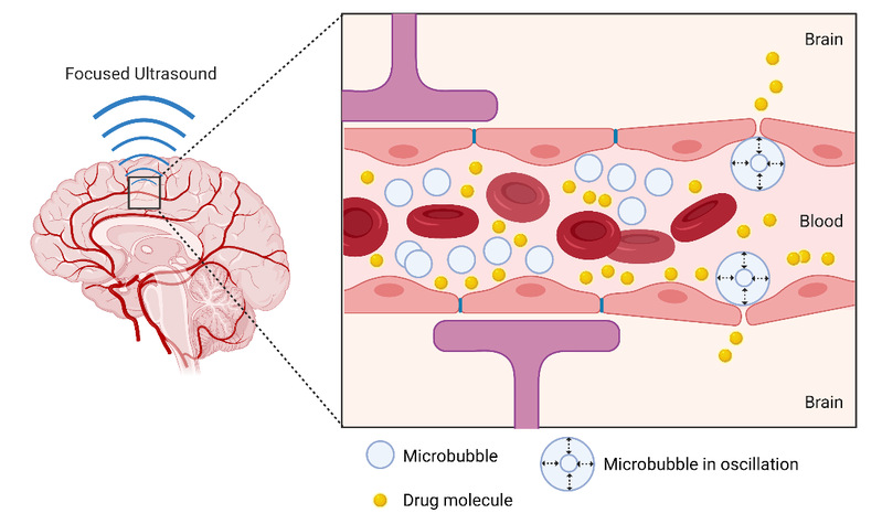 生医工学院程冰冰课题组在聚焦超声开放血脑屏障技术中取得新进展